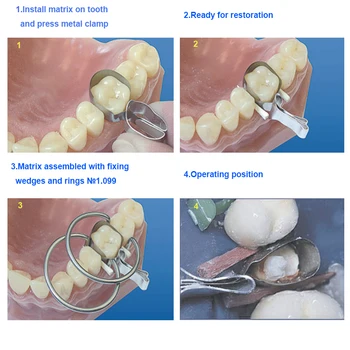 Dental Contorneada Matrices Metálicas No De La Matriz De Retención Required0.035mm Espesor Molares Matrices Metálicas Restauración Dental Herramientas